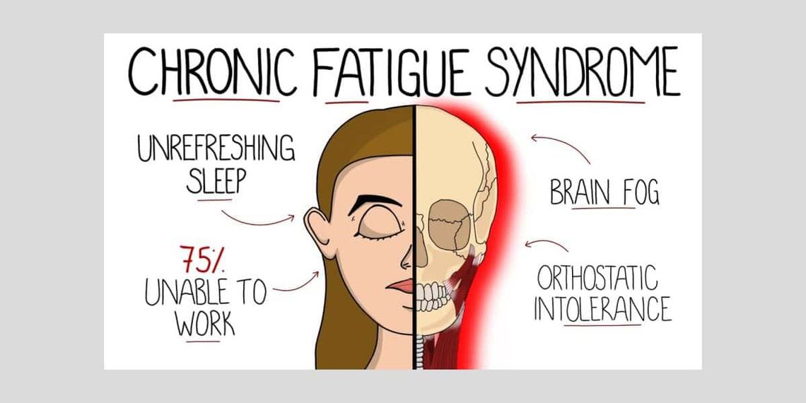 Chronic Fatigue Syndrome
